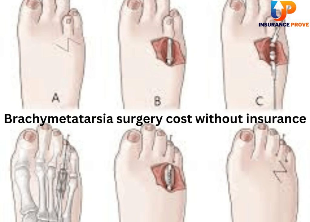 Brachymetatarsia surgery cost without insurance